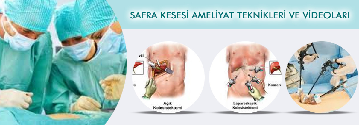 SAFRA KESESİ AMELİYAT TEKNİKLERİ VE VİDEOLARI